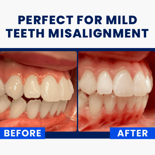 Overnight Teeth Straightening Kit (Full Set)